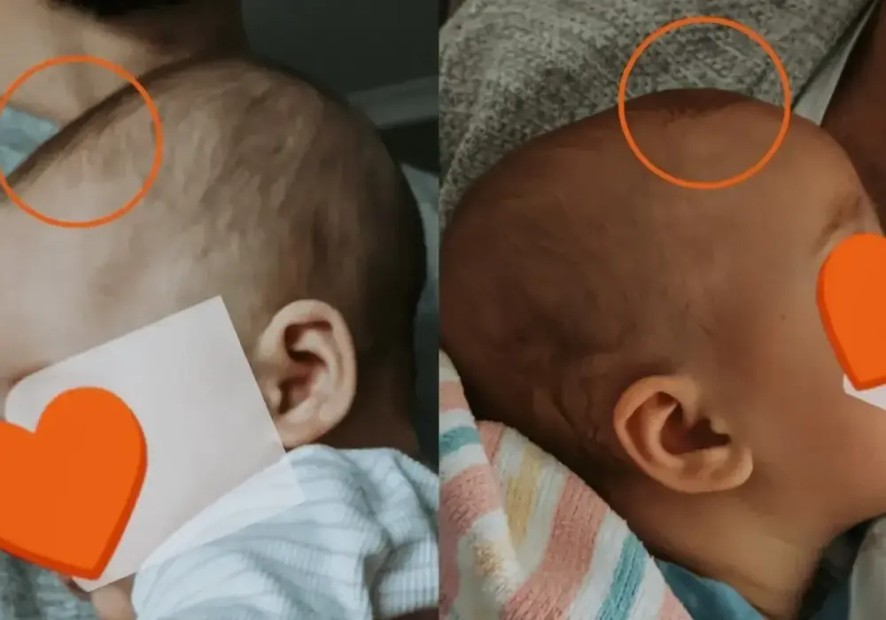 Ciemiączko u niemowlęcia - co jest normą, a kiedy do pediatry?
