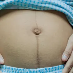 Brzuch kobiety w ciąży z widoczną ciemną linią biegnącą od pępka w dół, zwaną linea negra.
