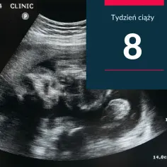 USG pokazuje zarodek w 8 tygodniu ciąży. Małe serduszko bije już mocno.