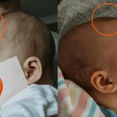 Dwa ujęcia główki niemowlaka. Na pierwszym widać delikatne zagięcie na ciemiączku, na drugim jest ono mniej widoczne.